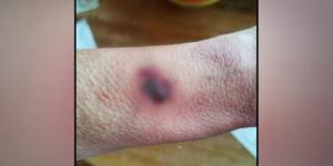 Fitbit Flex 2 Explodes, Causing The Wearer Second-degree Burns